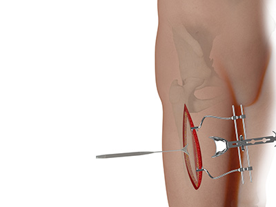Complex Hip Reconstruction Surgery - Educational Picture