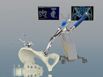 Computer-Navigated Total Hip Replacement - Educational Picture