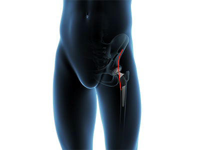 Direct Anterior Hip Replacement - Educational Picture
