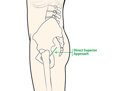 Direct Superior Hip Replacement - Educational Picture