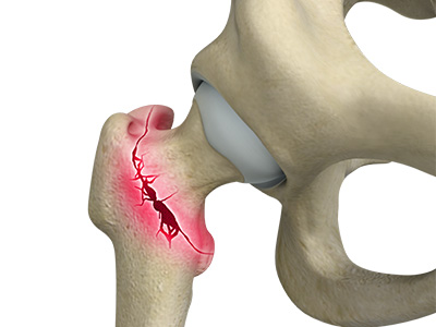 Hip Fracture - Educational Picture
