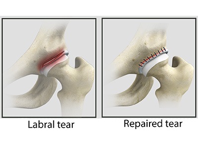 Hip Labral Repair - Educational Picture