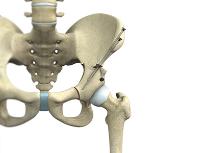 Hip Preservation Surgery - Educational Picture
