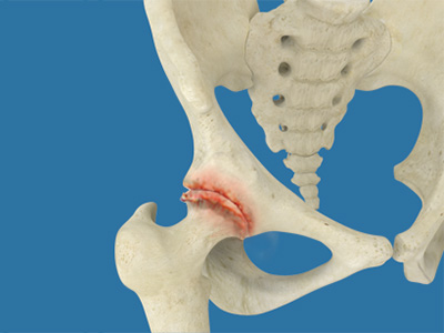 Osteoarthritis of the Hip - Educational Picture