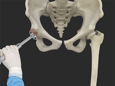 Robotic Assisted Hip Replacement - Educational Picture