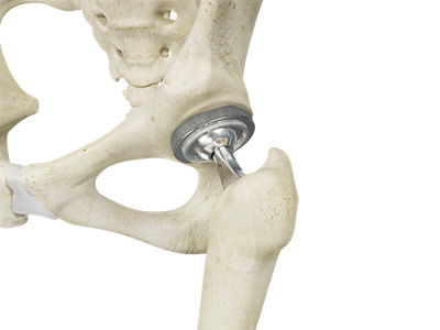 Total Hip Replacement - Educational Picture