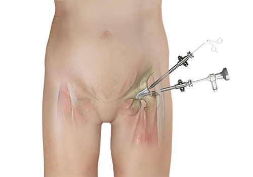 Hip Arthroscopy - Educational Picture