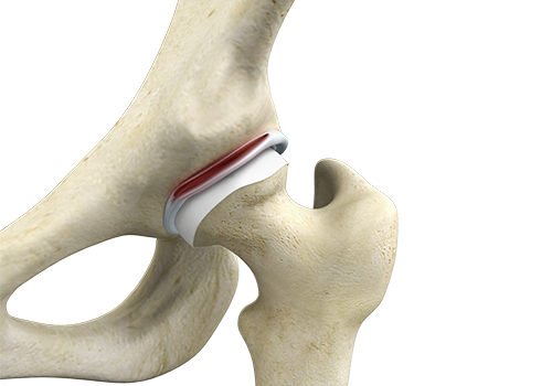 Hip Labral Tear - Educational Picture
