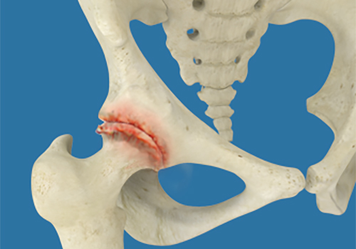 Osteoarthritis of the Hip - Educational Picture
