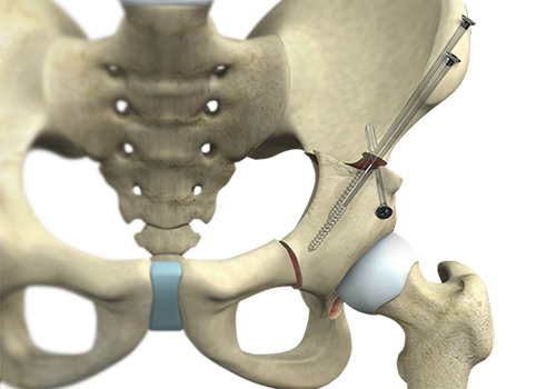Hip Preservation Surgery - Educational Picture