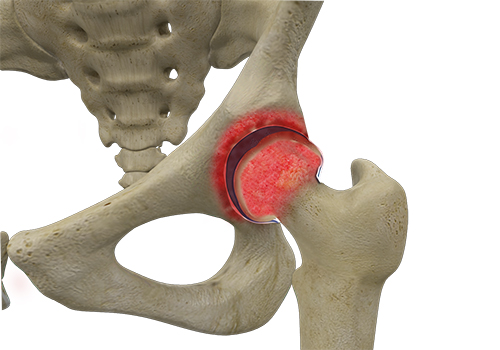 Rheumatoid Arthritis - Educational Picture