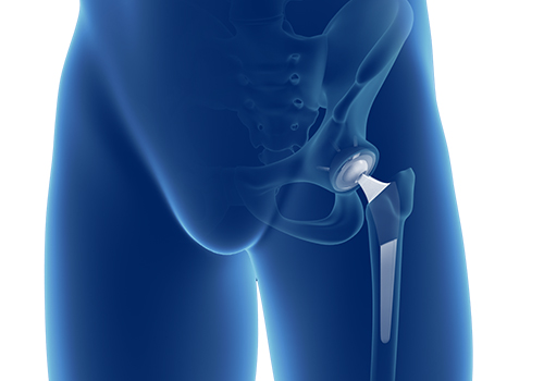 Total Hip Replacement - Educational Picture