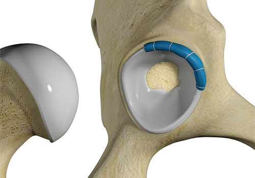 Hip Trauma Reconstruction - Educational Picture